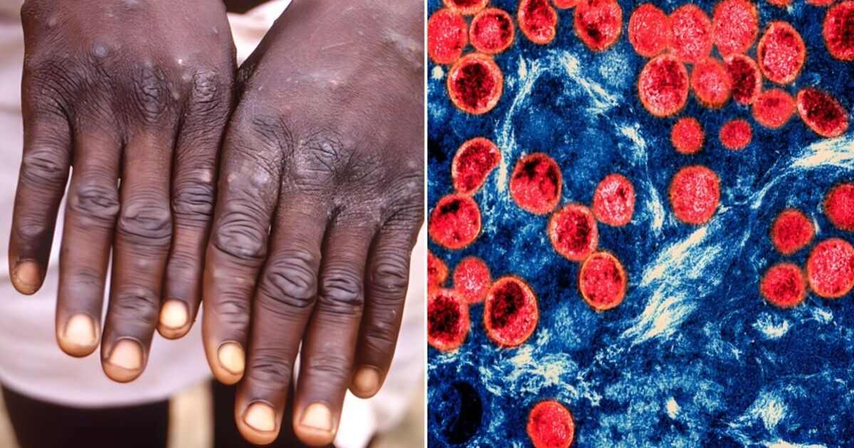 New monkeypox variant sparks emergency meeting by WHO as cases soar