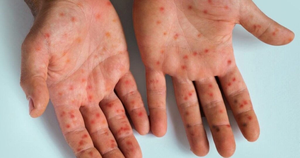 Sweden confirms first case of new Mpox variant outside of Africa | World | News